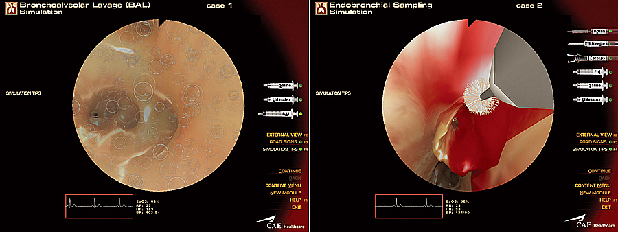 気管支肺胞洗浄(BAL) & 気管支内サンプリング(Endobronchial Sampling)