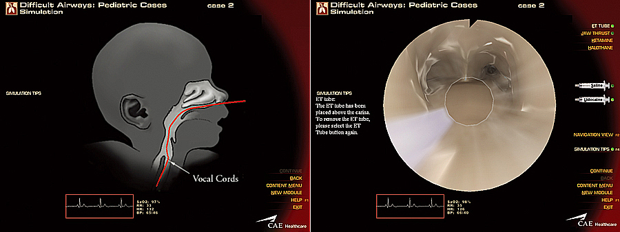 小児における挿管困難の症例(Pediatric Difficult Airways)