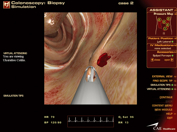 大腸内視鏡検査-生検(Biopsy)