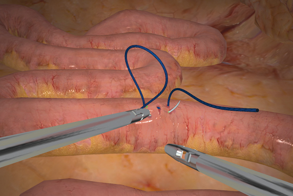 Suturing