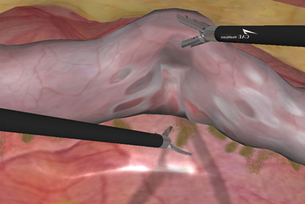 Adhesiolysis