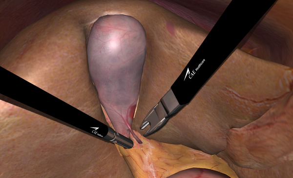 Laparoscopic Cholecystectomy