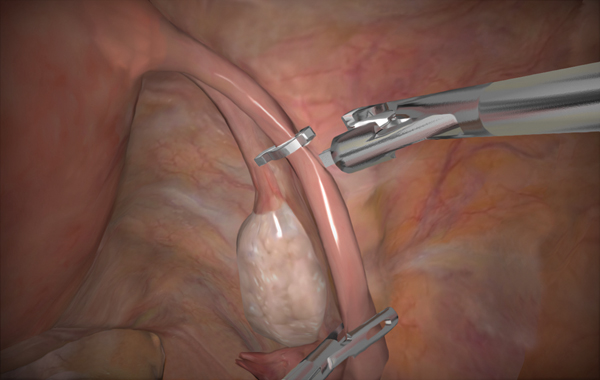 Bilateral Tubal Occulusion