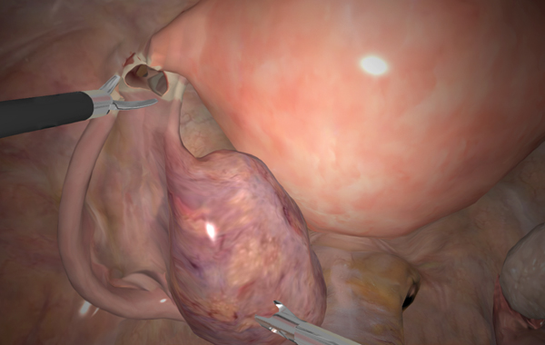 Salpingo-Oophorectomy