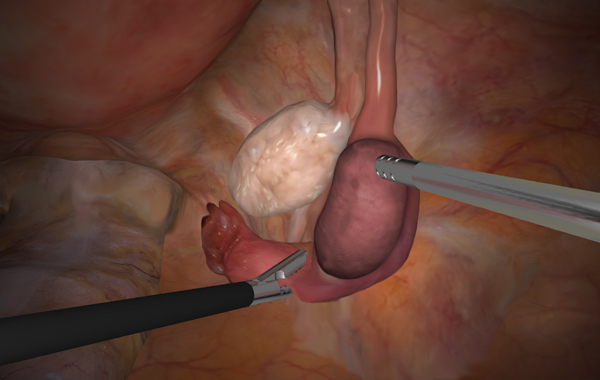 Ectopic Pregnancy