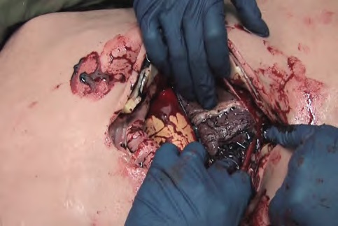surgicalcutsuit